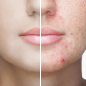 Acne Management