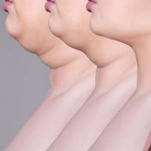 Kybella