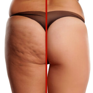 cellulite on legs