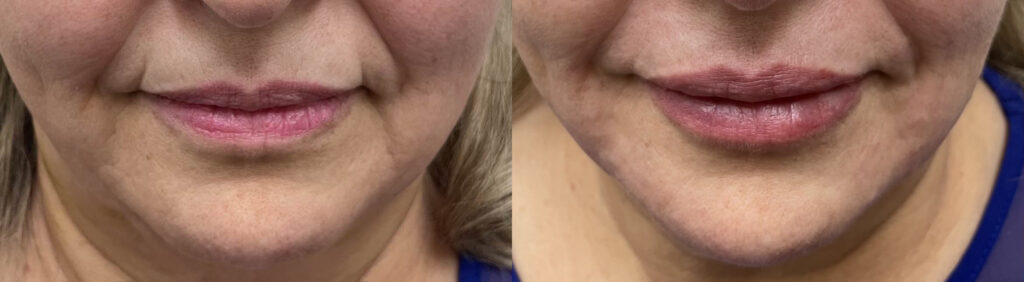 Dermal Fillers before and after photo by Dr. Naomi Fayzulayev in Pheonix, AZ