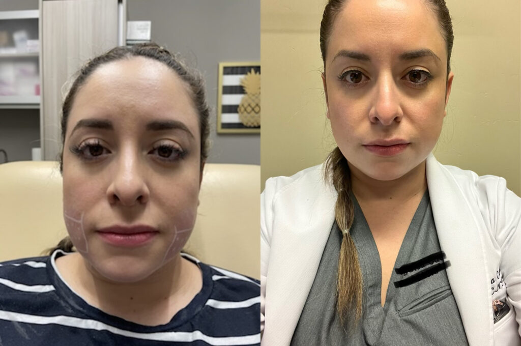 Fat Burning Injection before and after photo by Dr. Naomi Fayzulayev in Pheonix, AZ