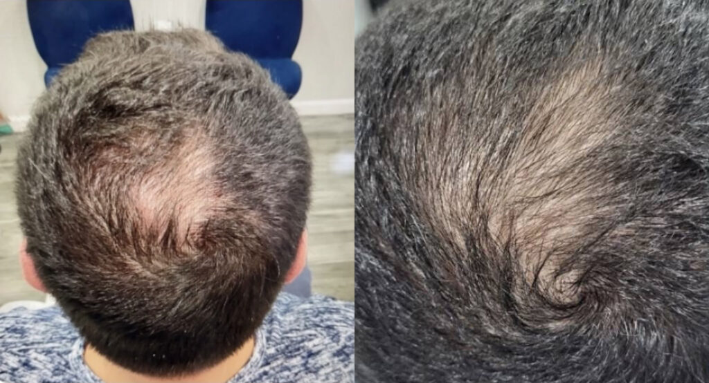 Hair Restoration before and after photo by Dr. Naomi Fayzulayev in Pheonix, AZ