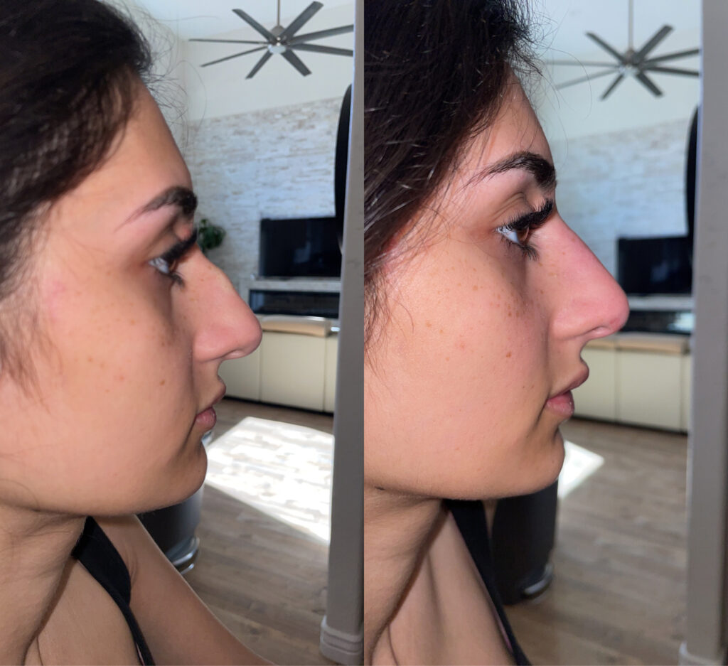 Non Surgical Rhinoplasty before and after photo by Dr. Naomi Fayzulayev in Pheonix AZ